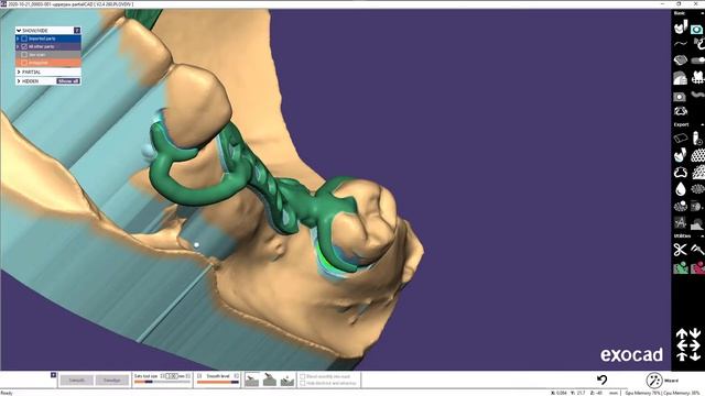 EXOCAD моделировка бюгельного протеза