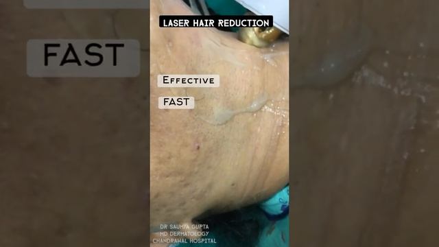 Laser Hair Reduction. Most Effective And Efficient Way To Get Rid Of Extra Hair Without Any Pain