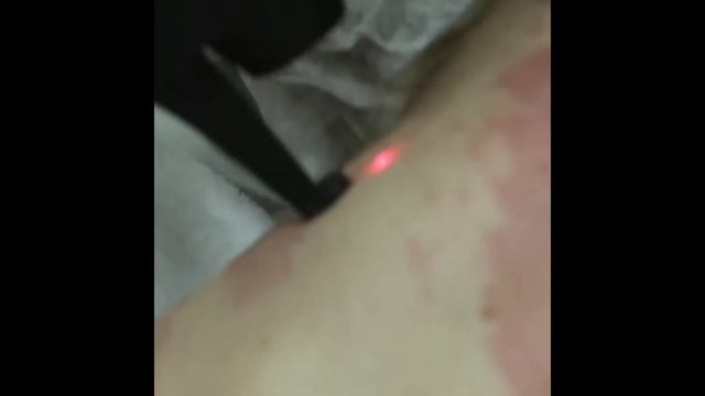 Акция на лазерную шлифовку кожи
