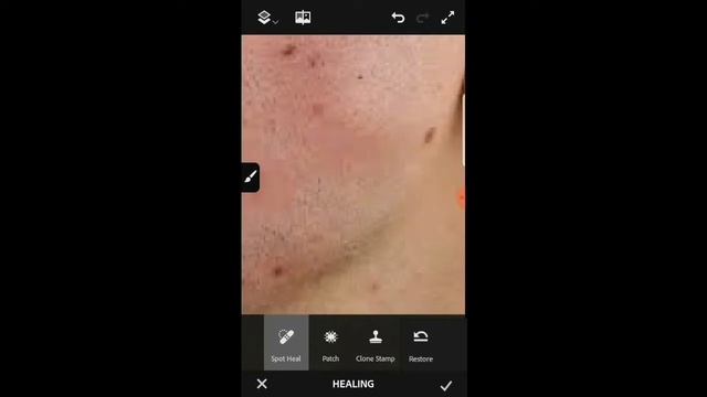 HOW TO REMOVE PIMPLES USING PHONE APPLICATION [ADOBE PHPTOSHOP FIX]