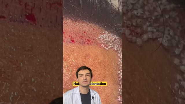 👨🏻🦱 Алопеция | Эффективное лечение выпадения волос ❗️