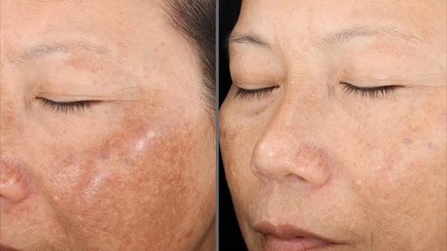 Мощные Способы Избавиться от Пятен после Родов?