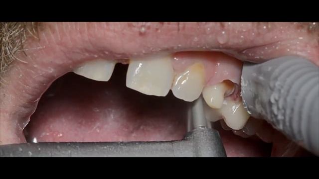 Установка эстетической коронки методом Cerec и PAG №2