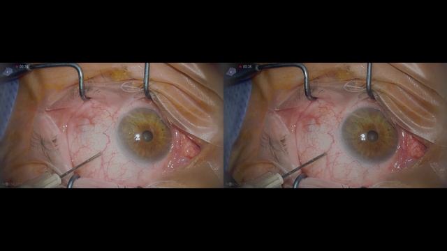 Supra Choroidal Triamcinolon Lukan Mishev Live Stream