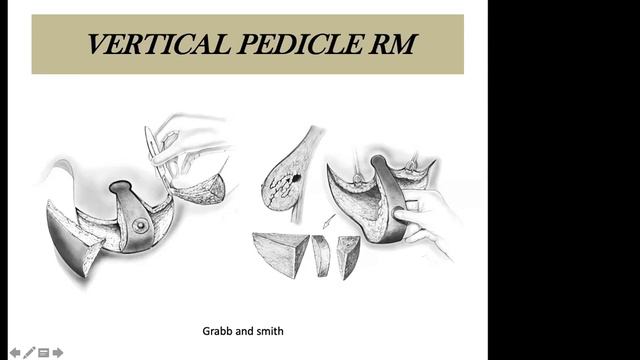 Principles Of Reduction Mammoplasty