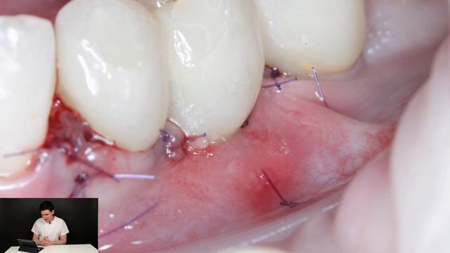 Мягкотканная пластика. Протокол увеличения объема мягких тканий вокруг имплантата.