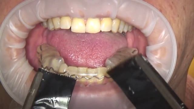 Bausch Arti-Fol® Metallic чёрная/красная BK 28 - 12µ