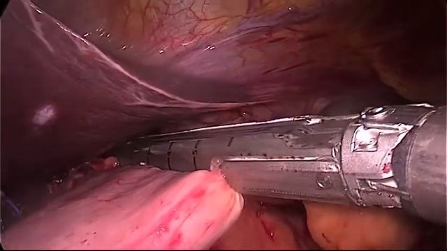 Gastroresezione Videolaparoscopica