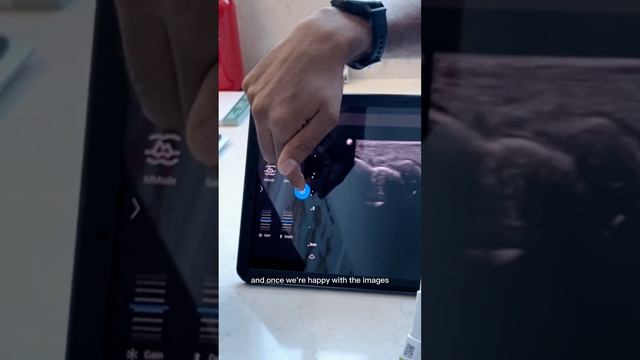 Portable #ultrasound: Philips Lumify - Scanning The Wrist (Part 3)