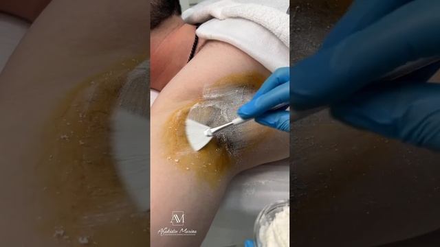 А вы знали, что Ботокс может решить такую проблему как повышенное потоотделение?!