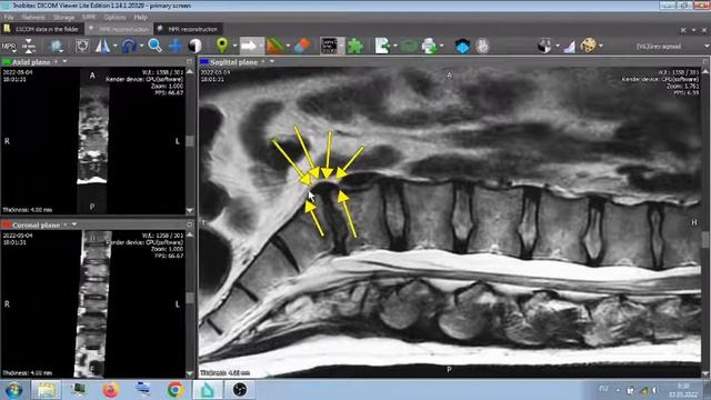 МРТ . ПАТОЛОГИЯ - S1 - L5