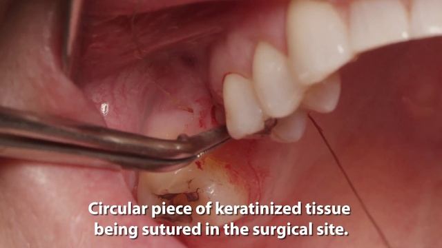 Placement Of A Bicon SHORT® Implant With A Sinus Lift Using Guided Surgery