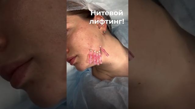 Нитевой лифтинг: подтяжка овала лица нитями