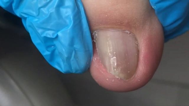 Solve The Inwardly Buckled Toenails For Patients~【Crazy Pedicure Room】