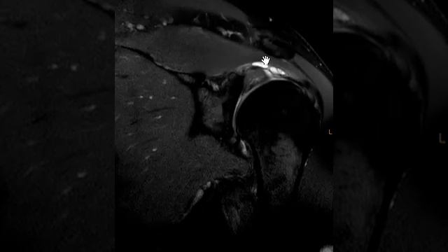 Mucoid Degeneration Of Labrum And Paralabral Cyst