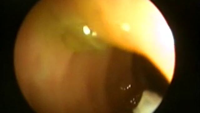 Иссечение полипа  Колоноскопия