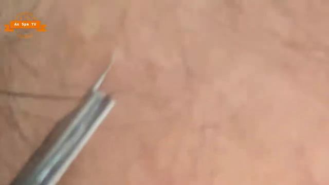 Удаление прыщей с носа и щек Spa G #060