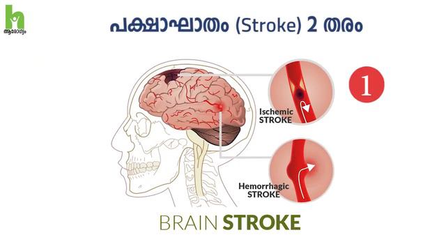 Stroke | സ്ട്രോക്ക് വരാതിരിക്കാൻ | Arogyam