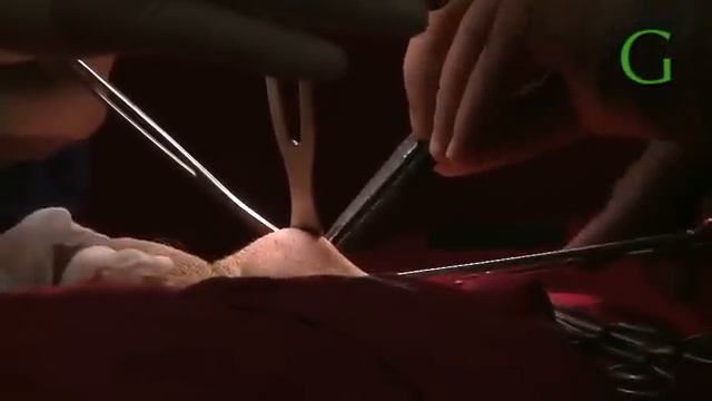 Д-р Ангел Енчев. Силиконов тестис.