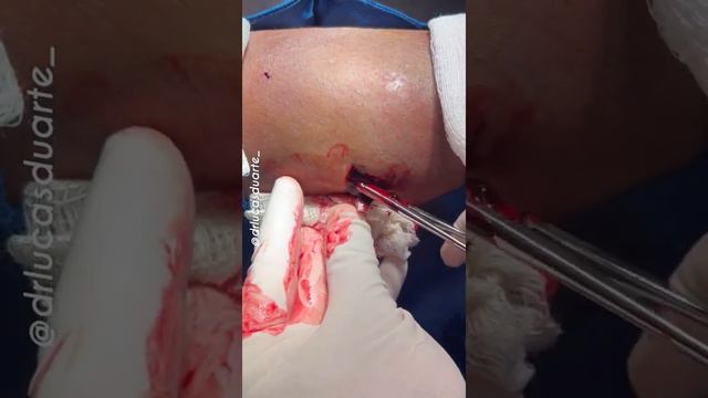 Drenagem De Hematoma • Haematoma Drainage - DR. LUCAS DUARTE [JAN22]