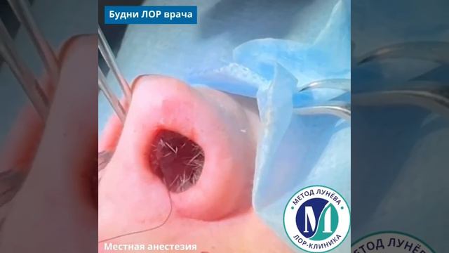Септопласика.
