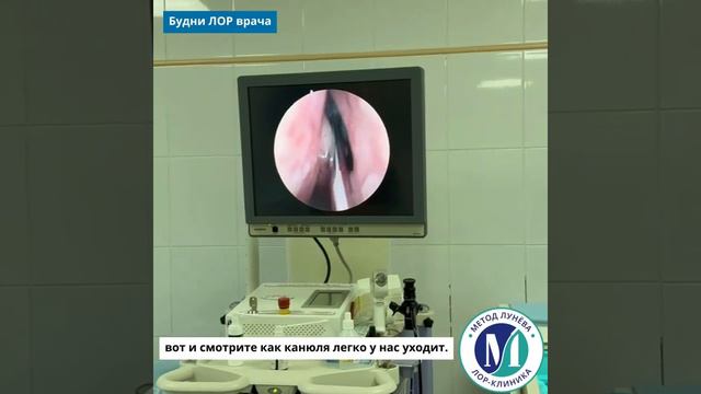 Зондирование лобной пазухи.