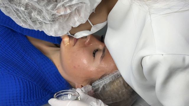 Механическая чистка лица