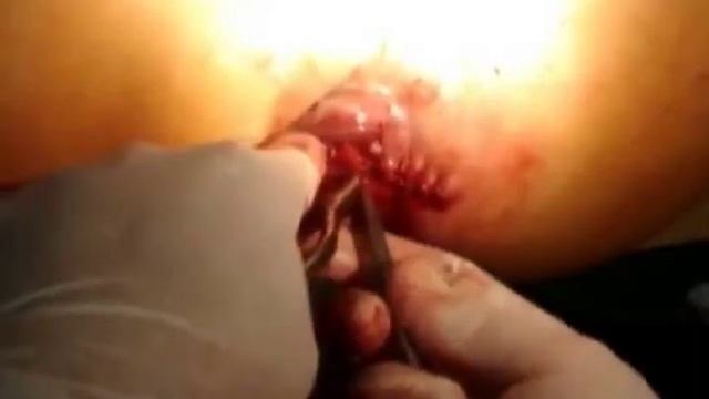 Геморроидэктомия: Удаление геморроя