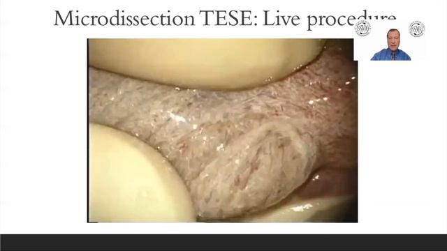 Surgical Management Of NOA
