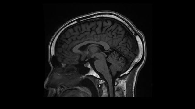 MRI Series 004 (SAG T1 FLAIR)
