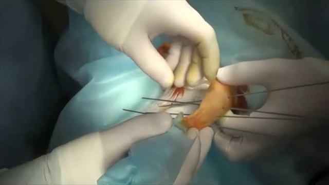 Хирургическое лечение перелома 22А3 у растущей собаки