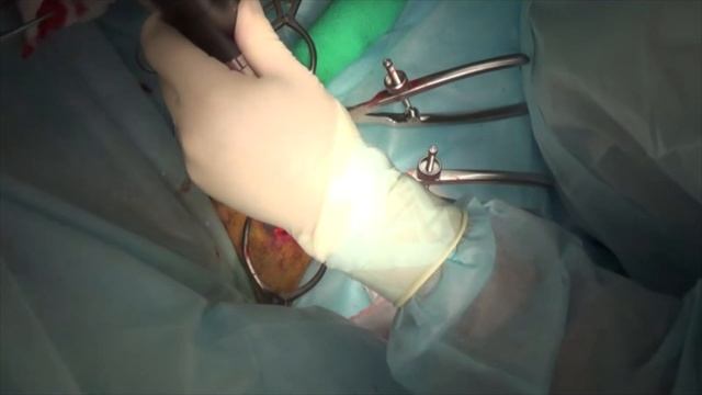 Хирургическое лечение перелома 42В1 у собаки