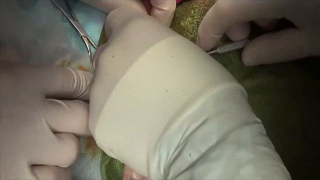 Хирургическое лечение разрыва ПКС на фоне деформации большеберцовой кости у собаки