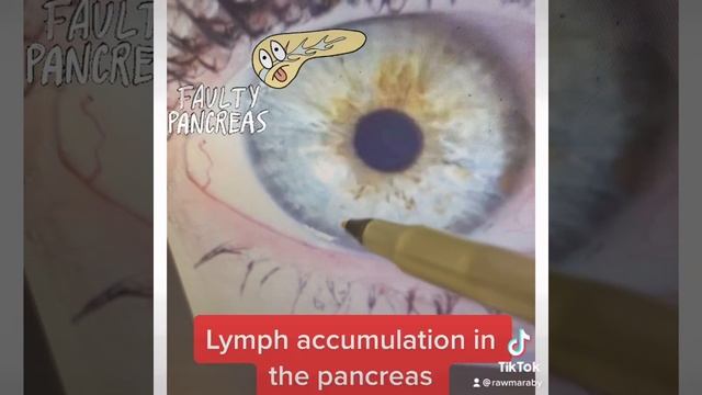 Weak Pancreas As Seen In The Eye