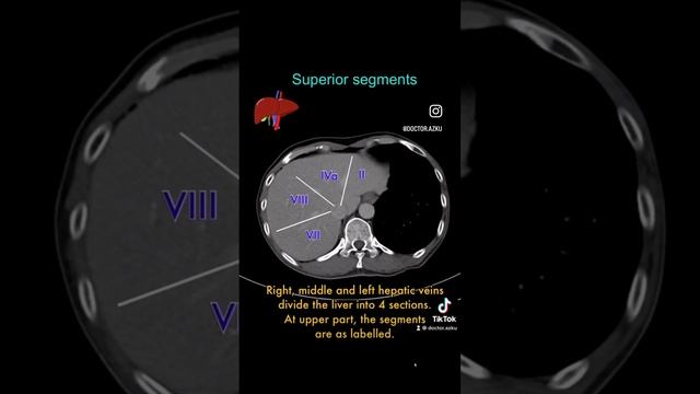 Liver Segments On CT Scan #CT #radiology #radiologist #liver