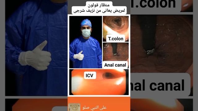 منظار قولون تشخيصى