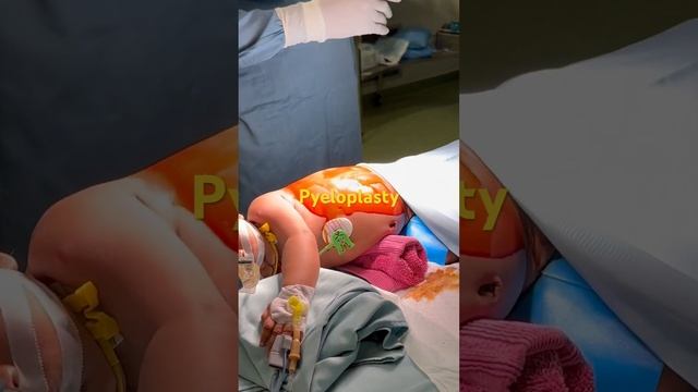 Pyeloplasty Fora 2 Months Old Child By Dr Mathula Hettiarachchi.👶👍#children #surgeon