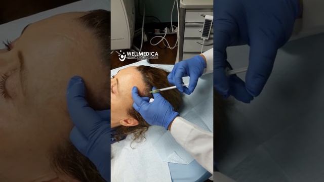 Mesotherapy With PRP For Hair Loss