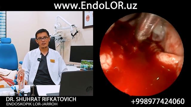#Endoskop Va #Sheyver Yordamida #Adenotomiya #operatsiyasi / #Операция #аденотомии - Lor24.uz