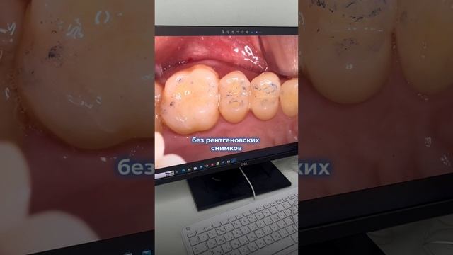 На какие нюансы надо обращать внимание при постановке пломб. В. А. Ш. СТОМАТОЛОГ НА ВДНХ Москва