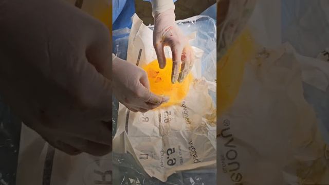 Извлеченный лопнувший имплант - почему мог произойти разрыв?