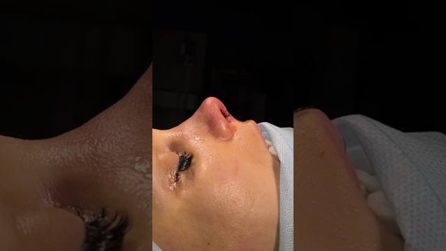 Ринопластика