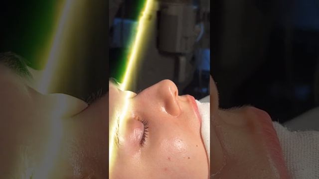 Rhinoplasty. Nosejob. Ринопластика.