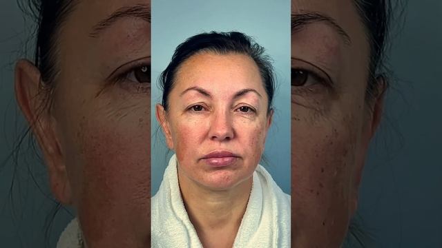 Блефаропластика. Верхняя блефаропластика.