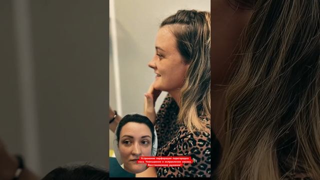 Ринопластика. Перфорация перегородки носа.