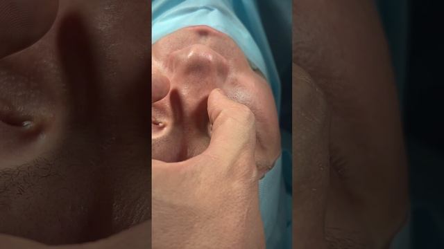 Ринопластика. Вторичная ринопластика. Риносептопластика.