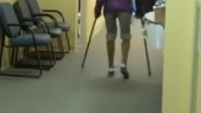 Double Amputee Walks with Bionic Prosthetic Legs Ossur Symbionic Prosthesis