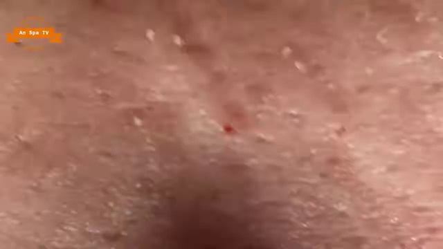 Удаление прыщей с носа и щек Spa G #044