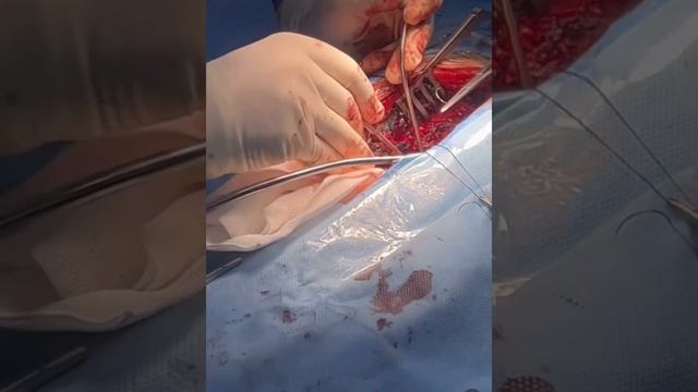 #spinal Cord Tumor