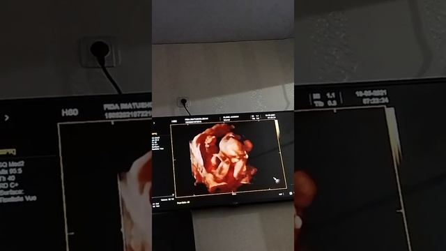 USG 2D 3D 4D Usia 18 Minggu 4 Bulan / 5 Bulan Bayi Tampak Nyata